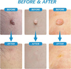 2 in 1 Skin Tag Remover Kit - Painless